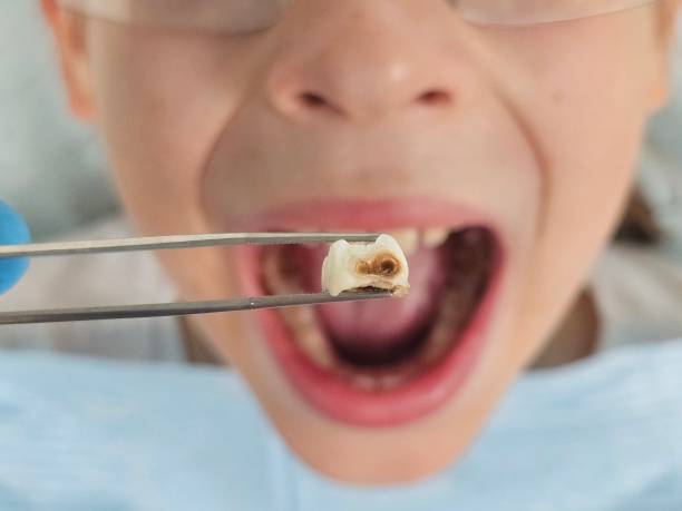 Best Emergency Dentist for Lost Fillings or Crowns in Amesti, CA